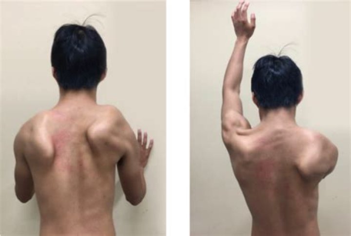 Deep phenotyping of facioscapulohumeral muscular dystrophy type 2 by magnetic resonance imaging - ePrints