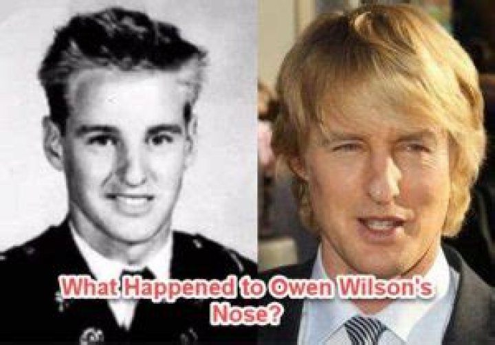 Here is what happened to Owen Wilson’s nose